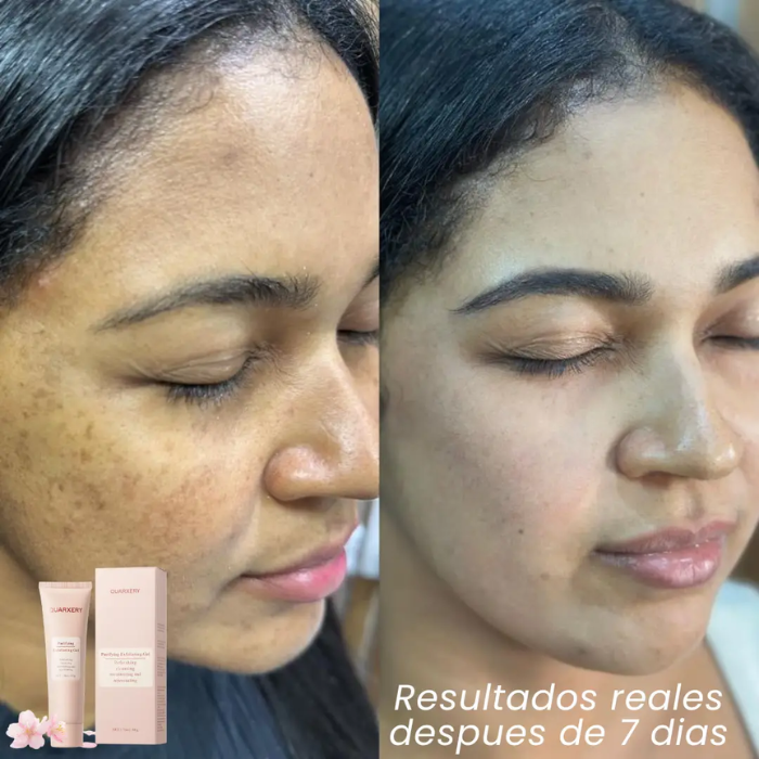 Quarxery Gel - Exfoliante Aclarador